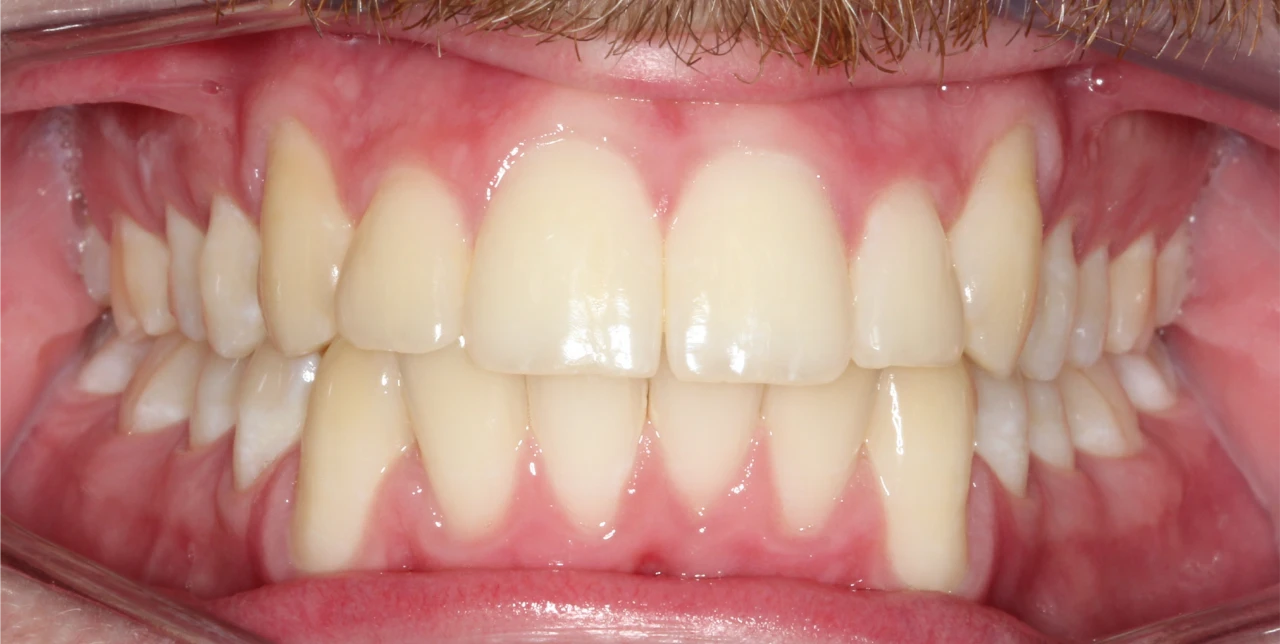 orthodontist-patient-hurstville-after-photo-teeth