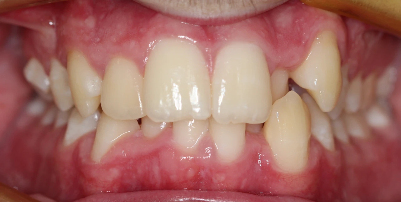 orthodontist-patient-hurstville-before-photo-teeth